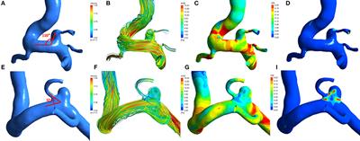 Hemodynamic and Morphological Differences Between Unruptured Carotid-Posterior Communicating Artery Bifurcation Aneurysms and Infundibular Dilations of the Posterior Communicating Artery